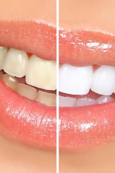 What Are The Advantages Of Cosmetic Dentistry | Tower House Dental Clinic